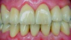 Information für Patienten und Zahnärzte: DROS-Schienen Therapie gegen Zähneknirschen